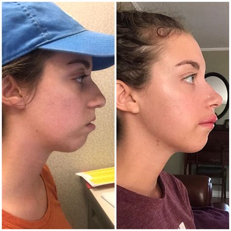 jaw surgery reddit